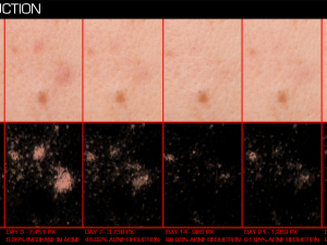 ACN11 Baseline, Day 3,7,14,21,28 Left 3-4 PhGx