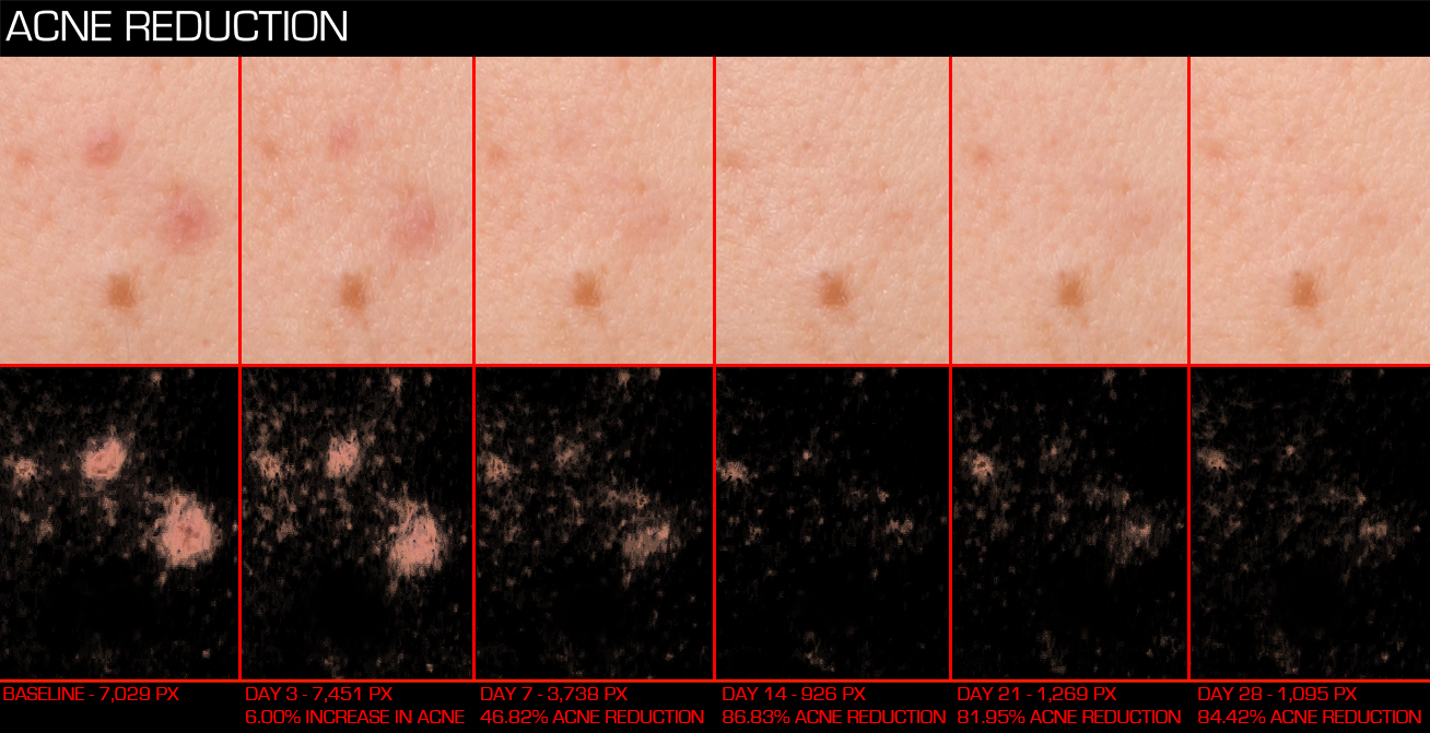 ACN11 Baseline, Day 3,7,14,21,28 Left 3-4 PhGx