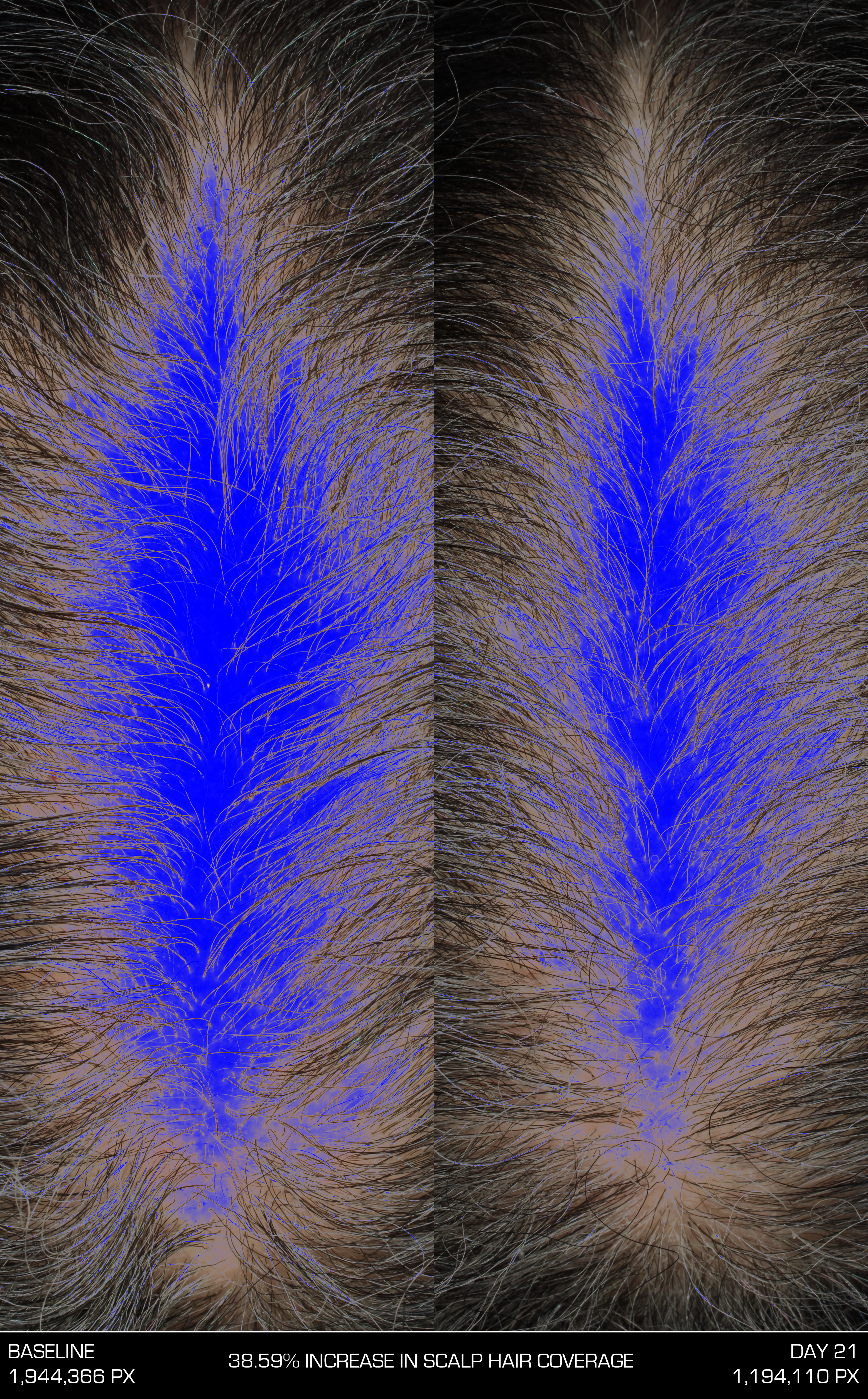 Hair Density Test - HAI30 46-8676 N-2905 Baseline, Day 21 PhGx