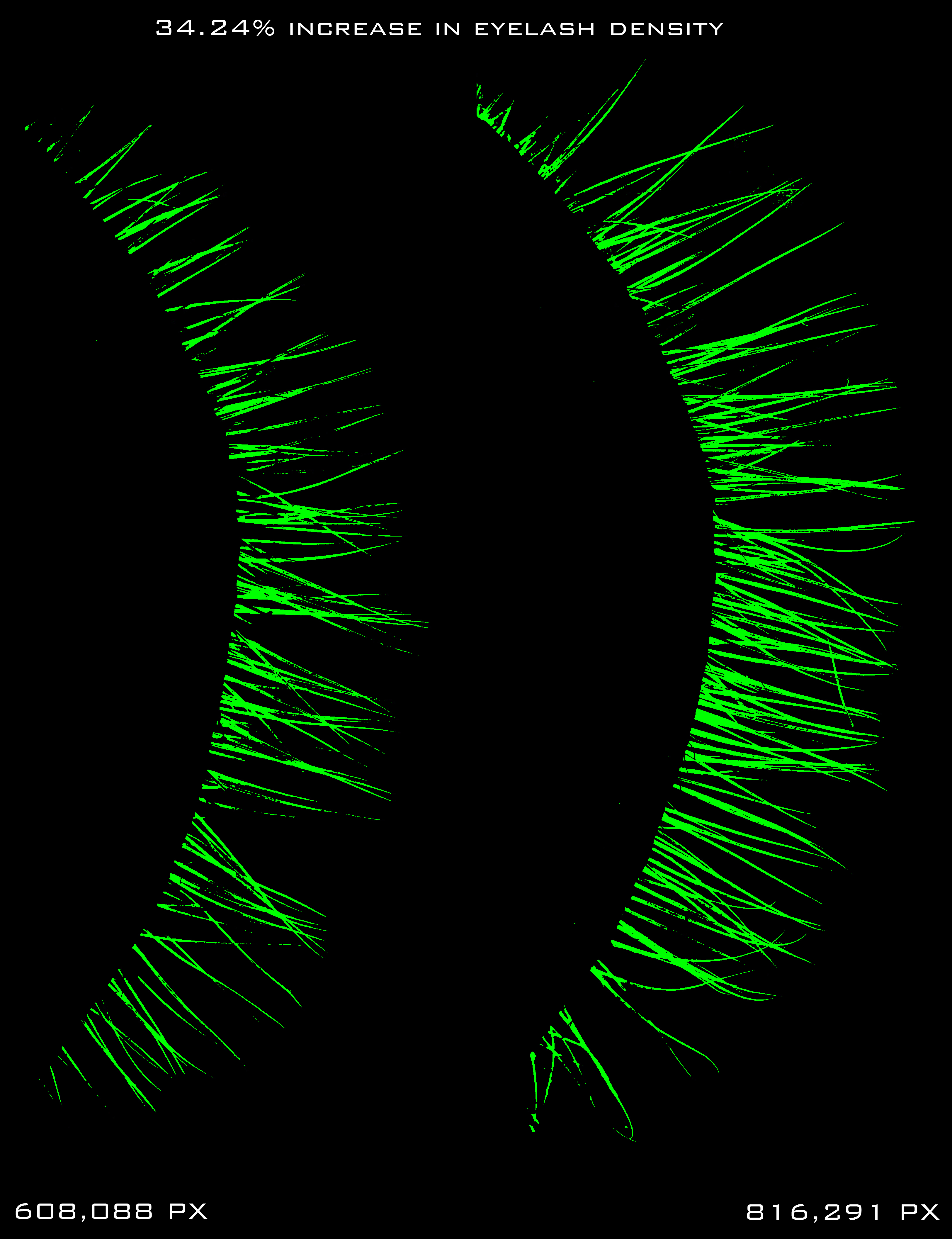 Photogrammetrix eyelash density Right Eye PhGx