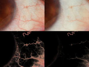 VAS01 Vascular Injection Baseline, Post App Right Eye