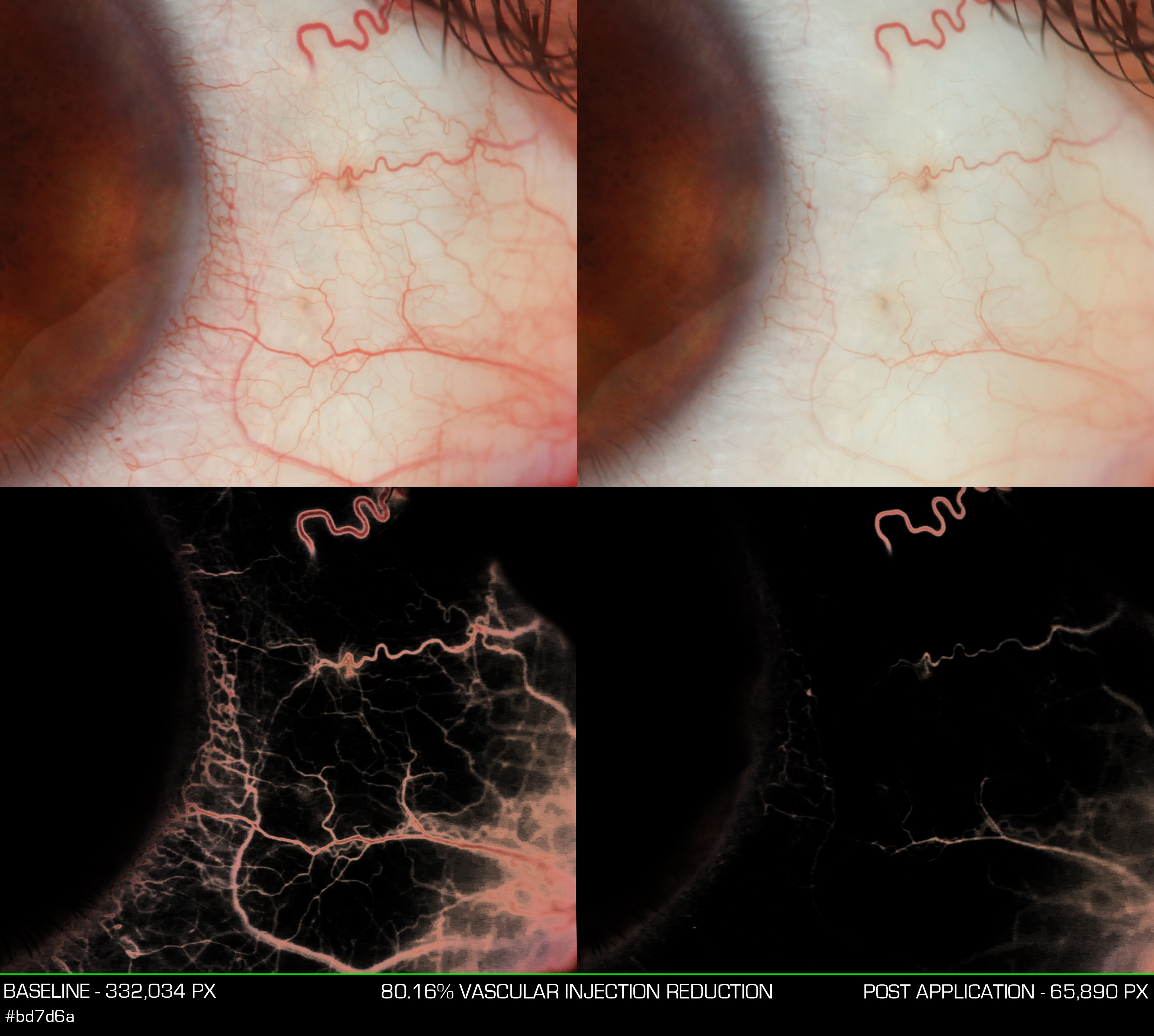 VAS01 Vascular Injection Baseline, Post App Right Eye