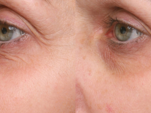 WRI05 54-2951 L-3106 L-3107  Left 3-4 Baseline Week 4A Undereye Wrinkles