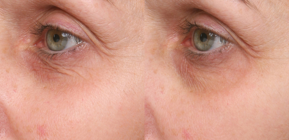 WRI05 54-2951 L-3106 L-3107  Left 3-4 Baseline Week 4A Undereye Wrinkles